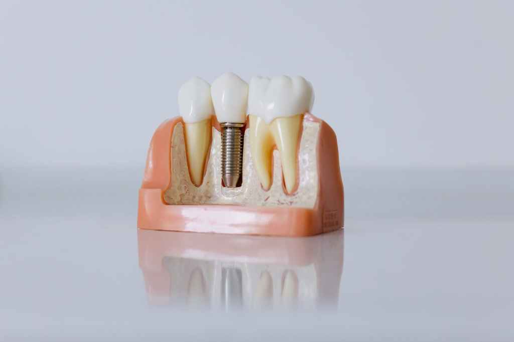 2023-05-23 15C ridge preservation – plan, preserve,&nbsp;prevent